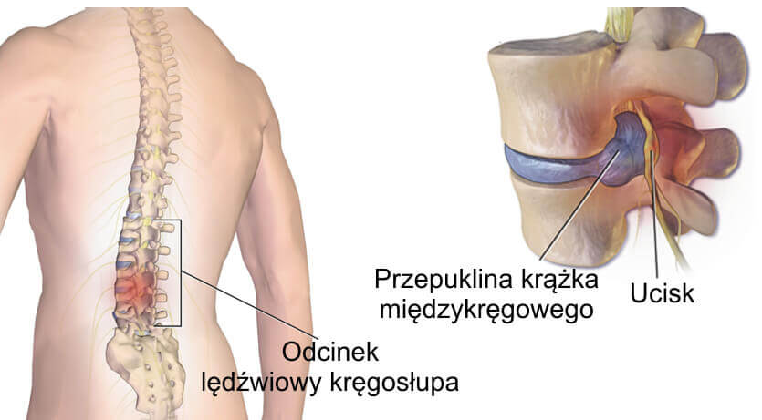 Przepuklina kręgosłupa